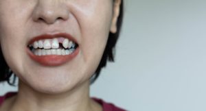 大量に歯が抜ける夢を見たら宝くじを買うべきかどうかは内容による
