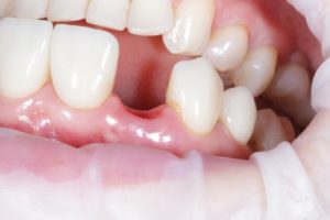 歯が抜ける夢を見た時は体調不良やストレスの暗示であることが多い